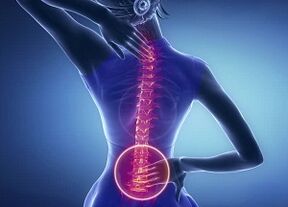 Projevy bederní osteochondrosy